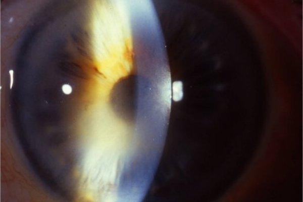 Mecanismos moleculares involucrados en enfermedades inflamatorias oculares