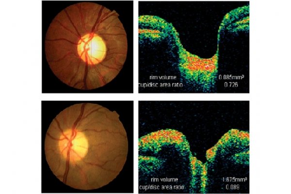 Mecanismos moleculares involucrados en enfermedades inflamatorias oculares